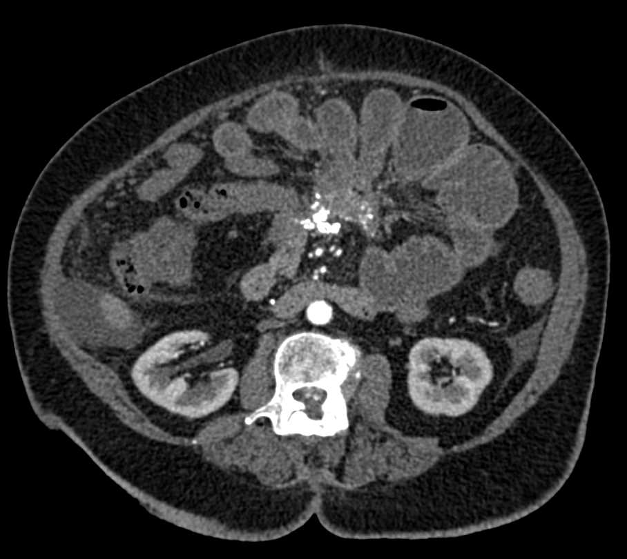 Sclerosing Mesenteritis Simulating a Mesenteric Carcinoid Tumor - CTisus CT Scan