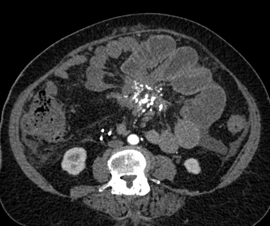 Sclerosing Mesenteritis Simulating a Mesenteric Carcinoid Tumor - CTisus CT Scan