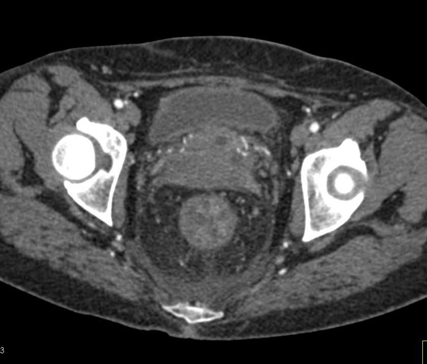 Crohn's Disease with Entero-enteric Fistulae - CTisus CT Scan