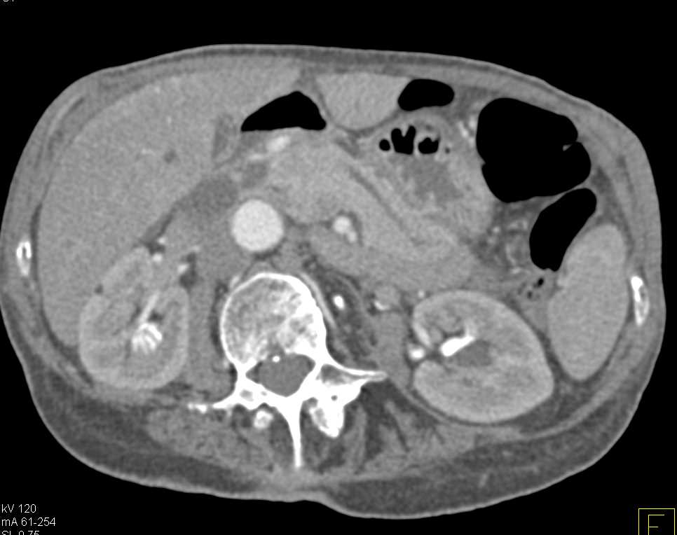 Carcinoma of the Duodenum - CTisus CT Scan