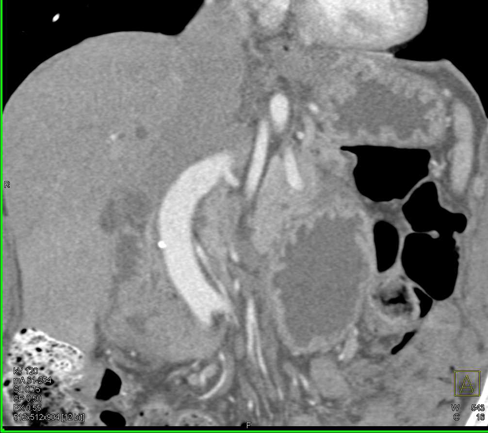 Carcinoma of the Duodenum - CTisus CT Scan