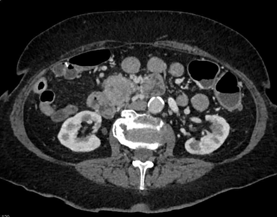 Carcinoid Tumor with Desmoplastic Reaction Near the Head of the Pancreas - CTisus CT Scan