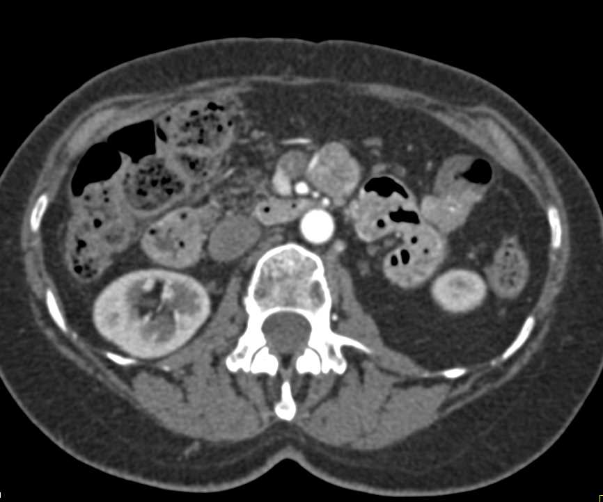 Recurrent Carcinoid Tumor Invades the Superior Mesenteric Vein (SMV) - CTisus CT Scan