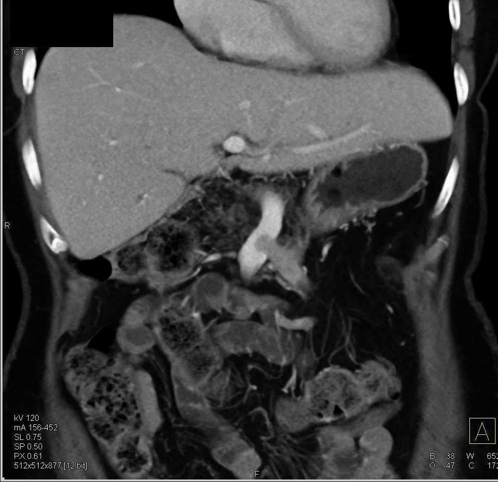 Recurrent Carcinoid Tumor Invades the Superior Mesenteric Vein (SMV) - CTisus CT Scan