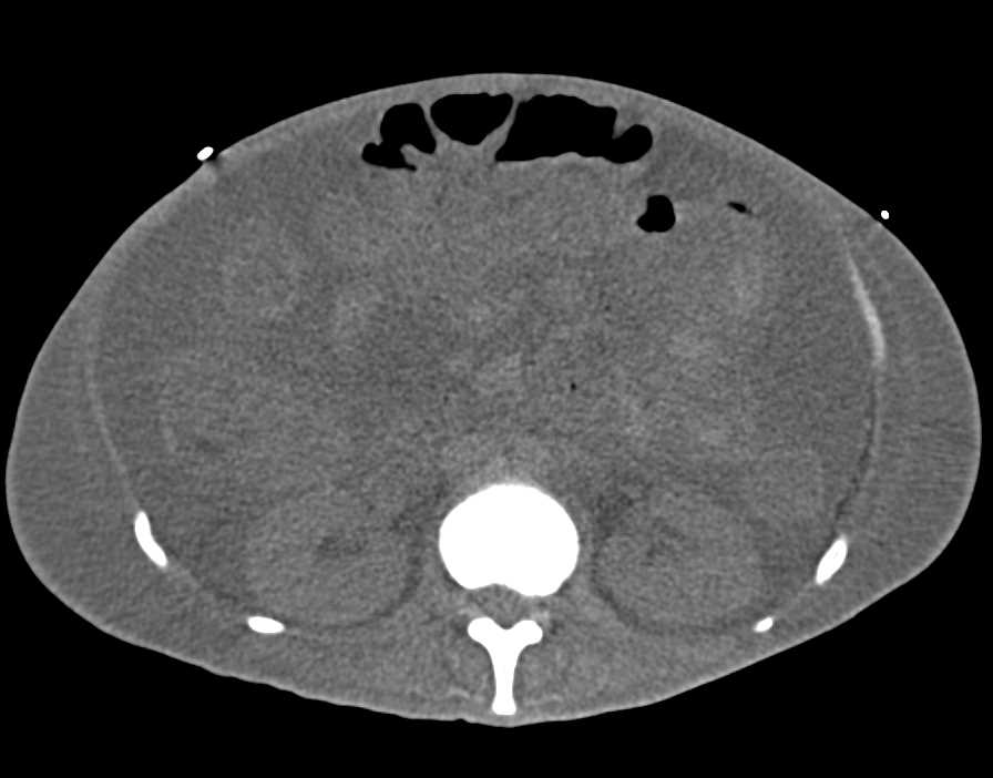 Small Bowel Bleeding Seen on a Non-contrast CT - CTisus CT Scan