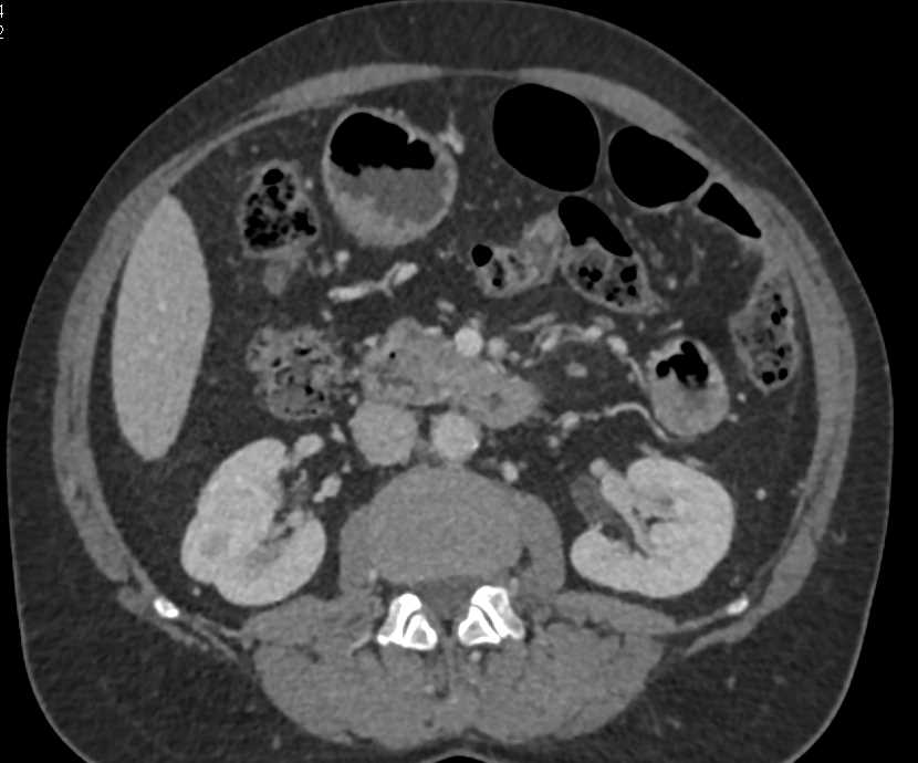 Subtle Duodenal Carcinoma - CTisus CT Scan