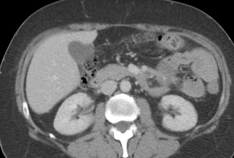 Carcinoid Tumor Near Jejunum in Mesentery - CTisus CT Scan