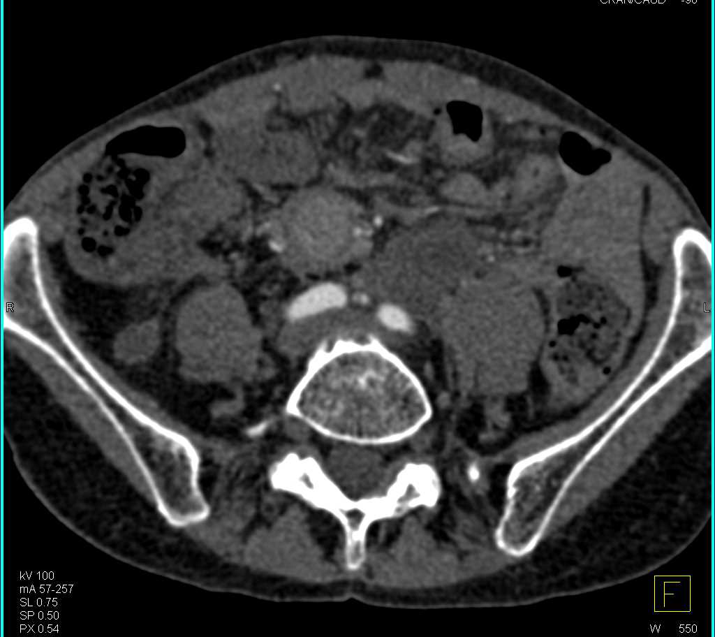 Carcinoid Tumor Root of Mesentery - CTisus CT Scan