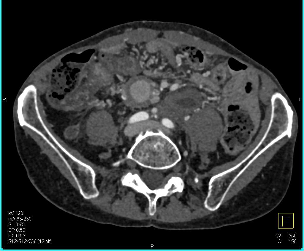 Carcinoid Tumor Root of Mesentery with Desmoplastic Reaction - CTisus CT Scan