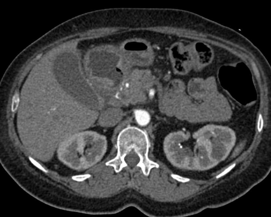 Duodenal Cancer Simulates a Pancreatic Tumor - CTisus CT Scan