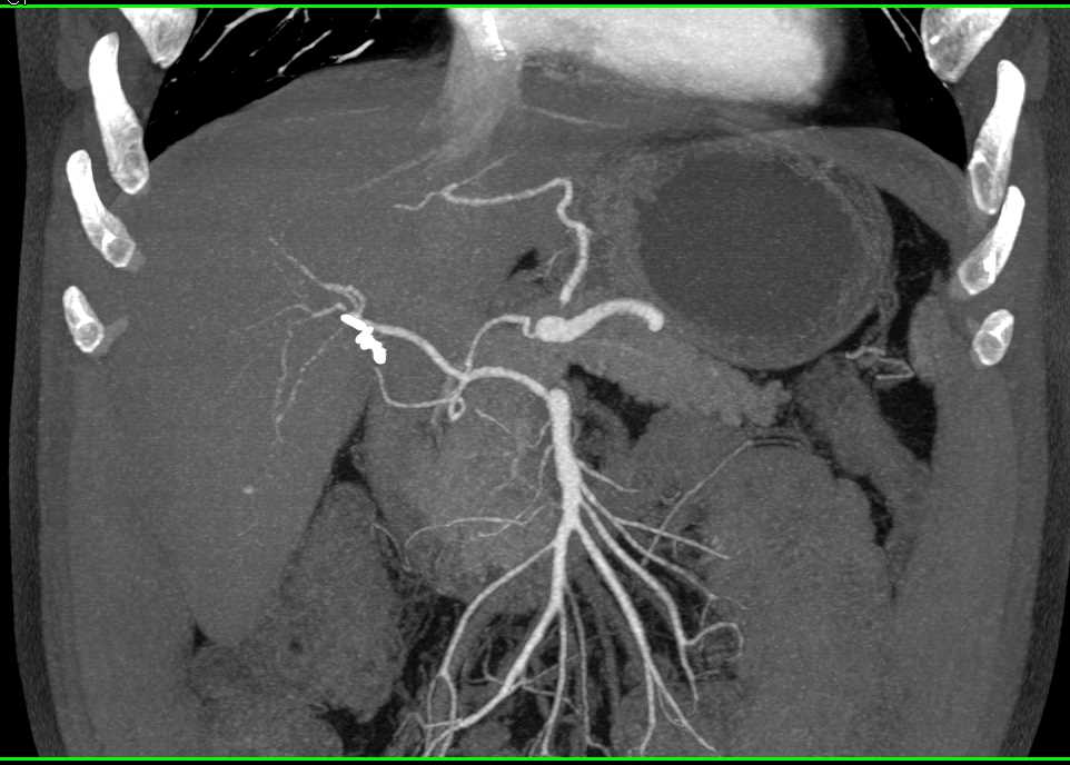 Duodenal Cancer Simulates a Pancreatic Tumor - CTisus CT Scan