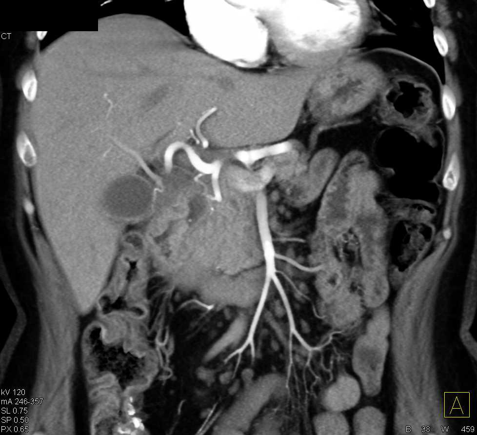 Duodenal Carcinoma - CTisus CT Scan