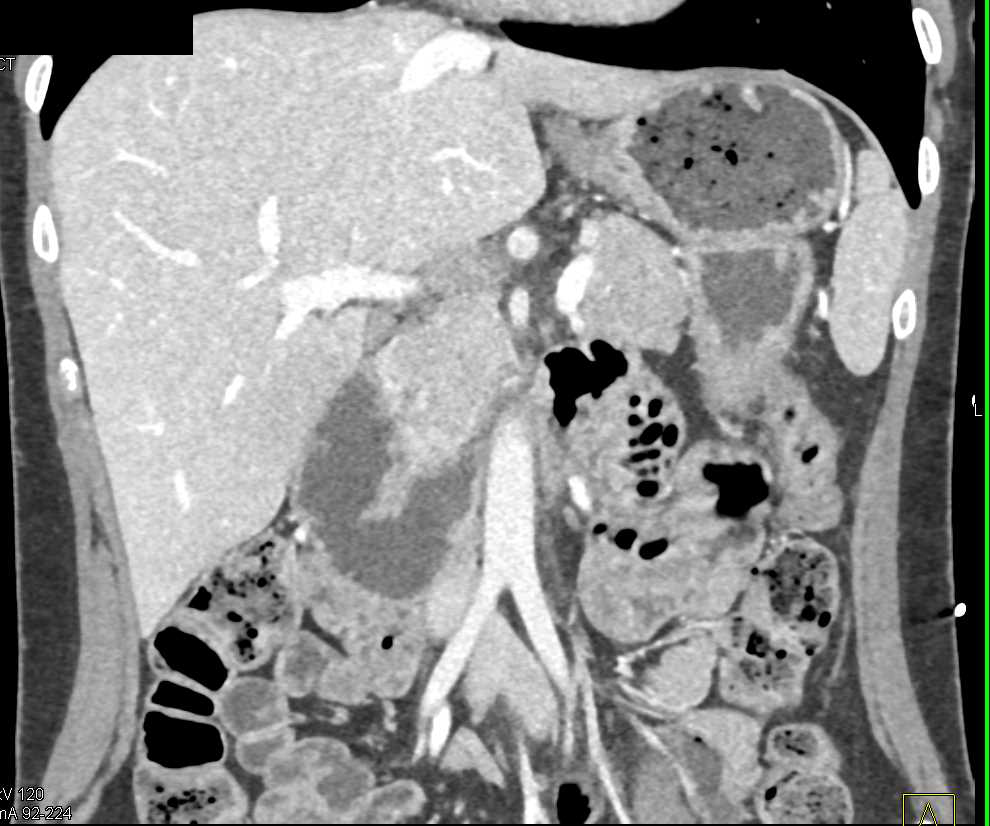 Dilated Duodenum Without a Mass - CTisus CT Scan