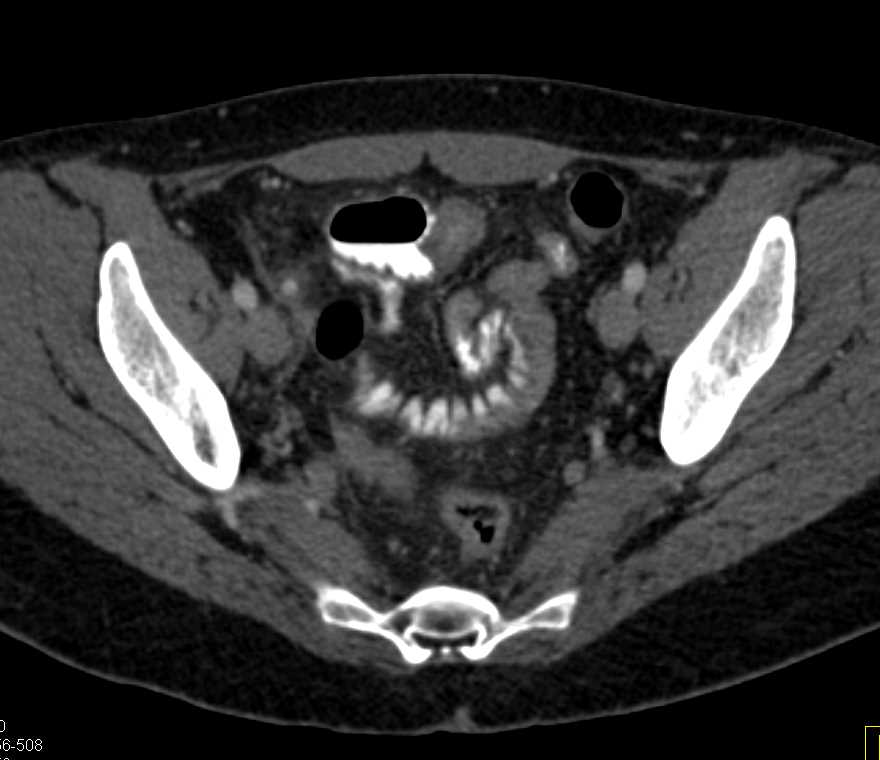 Infectious Enteritis Ileum - CTisus CT Scan