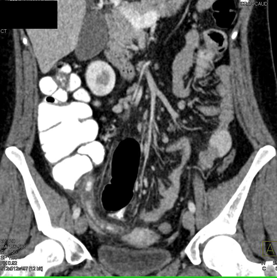 Infectious Enteritis Ileum - CTisus CT Scan