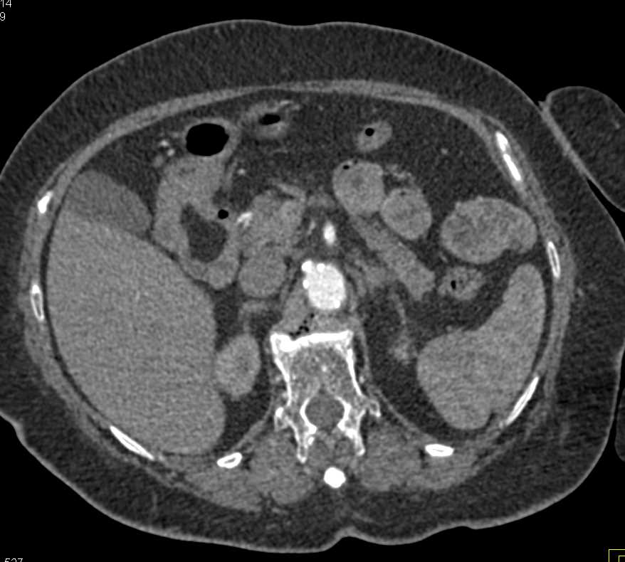 Duodenal Lipoma - CTisus CT Scan