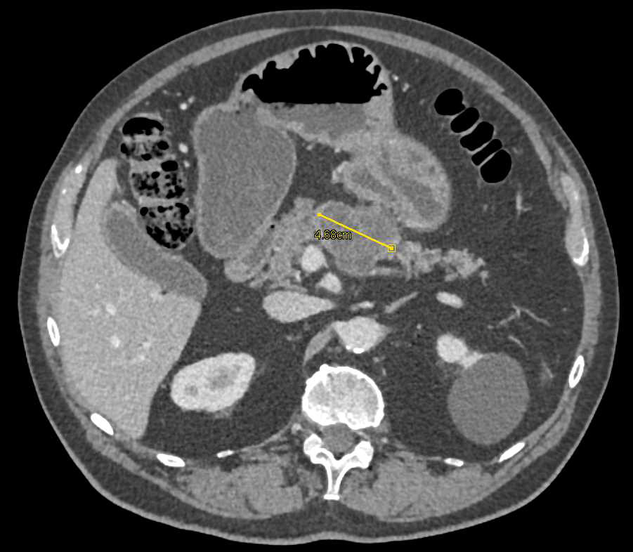 Incidental Small Bowel Lipoma (Jejunum) in Patient with MCN (Mucinous Cystic Neoplasm) Pancreas - CTisus CT Scan