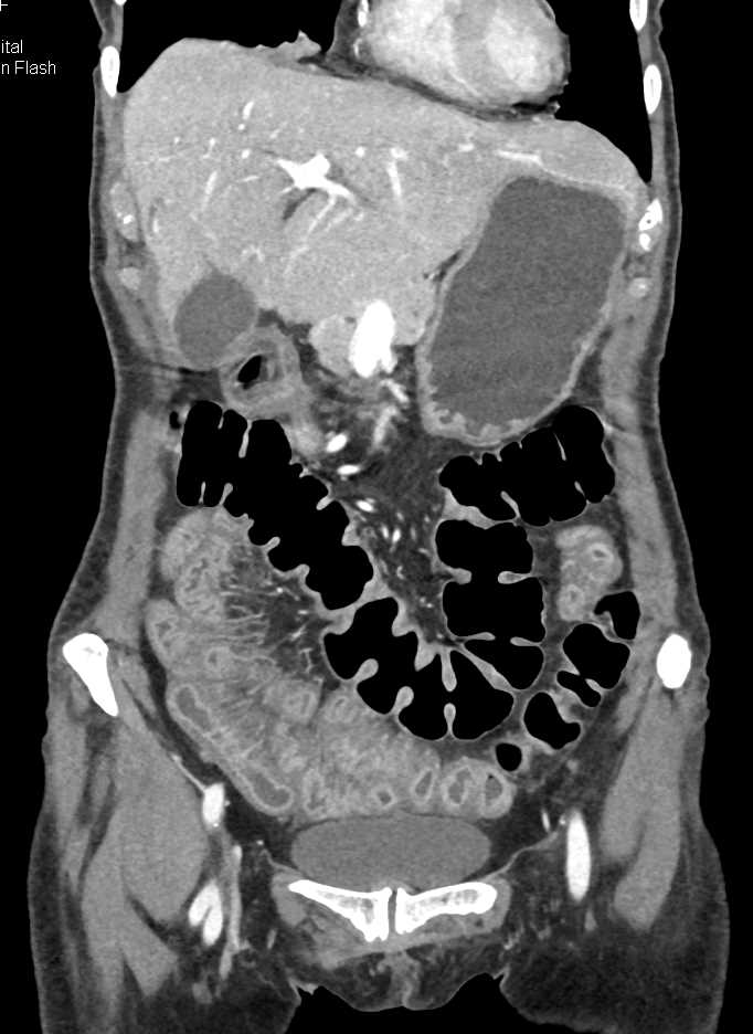 Thickened Distal Small Bowel with Graf vs Host Disease post-Bone Marrow Transplant (GVHD) - CTisus CT Scan