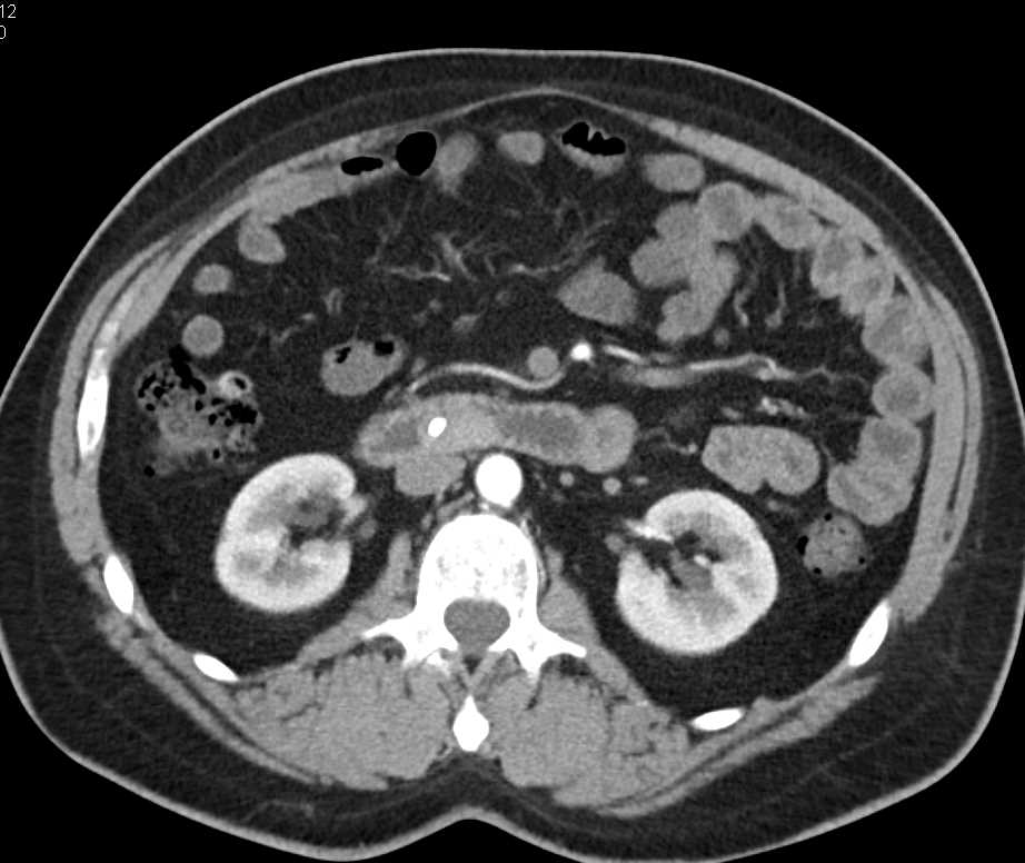 Duodenal Carcinoma in 3D - CTisus CT Scan