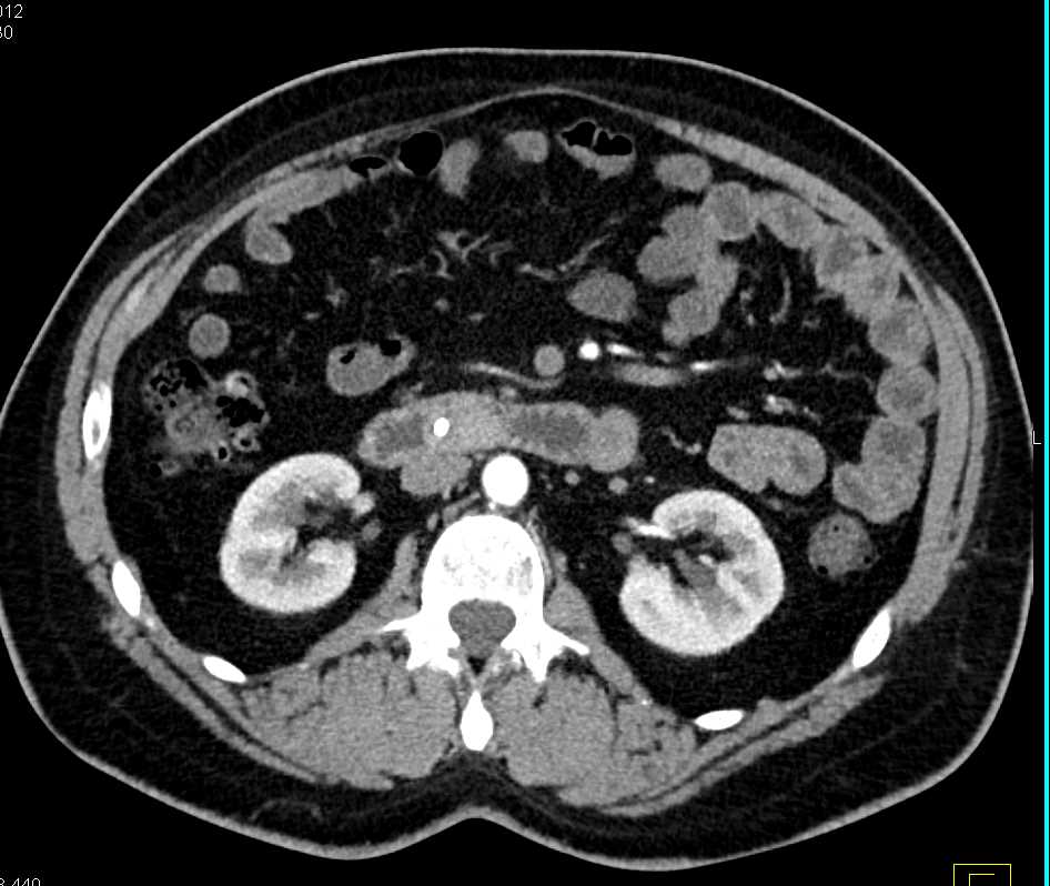 Duodenal Carcinoma Extends Towards Ampullary Zone - CTisus CT Scan