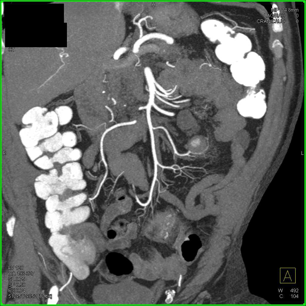 Bleeding Pseudoaneurysm off Jejunal Branches - CTisus CT Scan