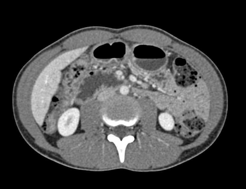 Superior Mesenteric Artery (SMA) Syndrome with Dilated Duodenum - CTisus CT Scan