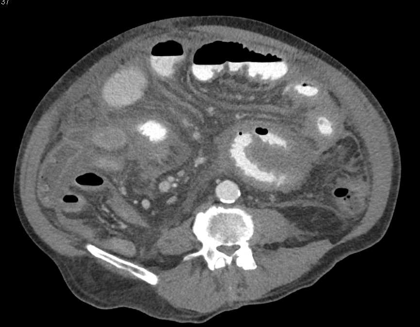 Infectious Enterocolitis - CTisus CT Scan