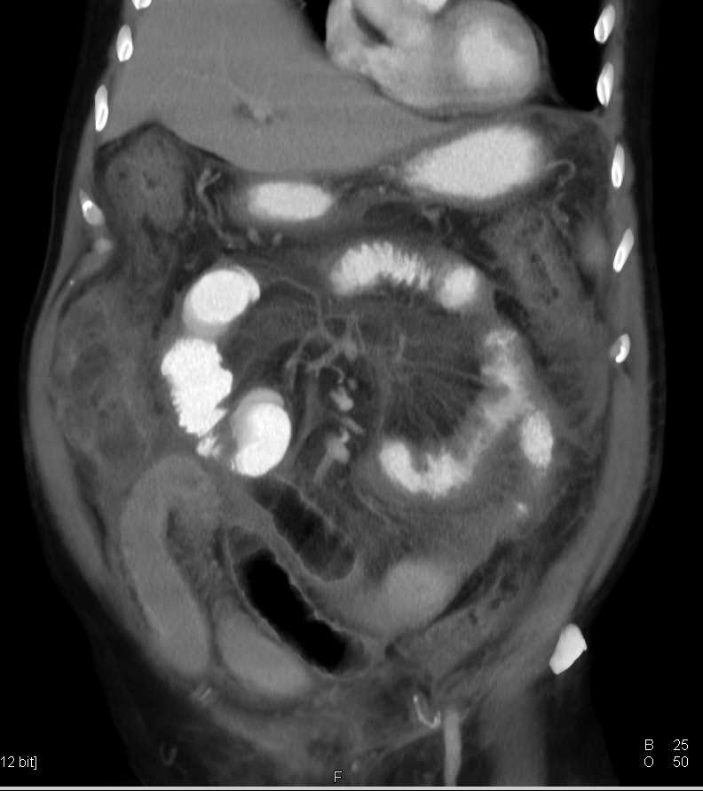 Infectious Enterocolitis - CTisus CT Scan