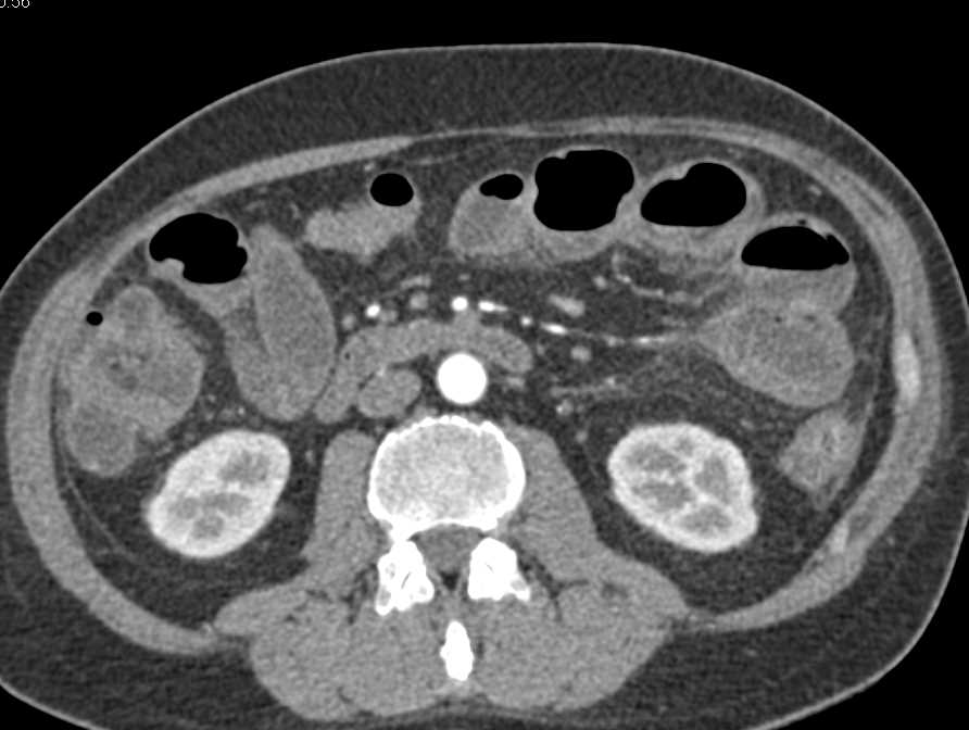 Distal Small Bowel Obstruction (SBO) due to Inflammatory Bowel Disease - CTisus CT Scan