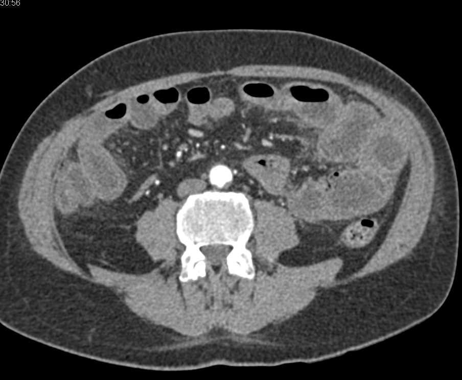 Dilated and Thickened Small Bowel due to Crohn's Disease - CTisus CT Scan