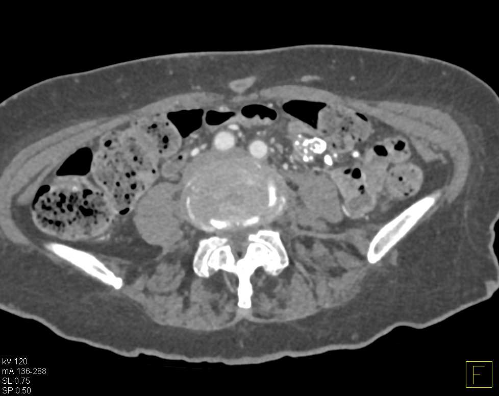 Sclerosing Mesenteritis - Small Bowel Case Studies - CTisus CT Scanning