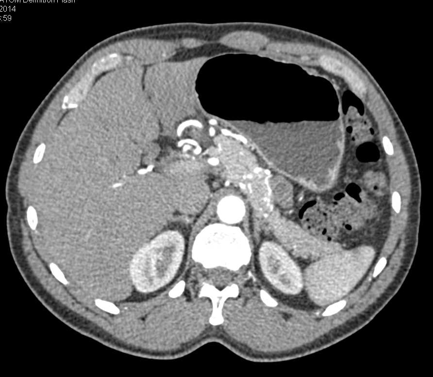 Sclerosing Mesenteries with Infiltration Mesentery - CTisus CT Scan