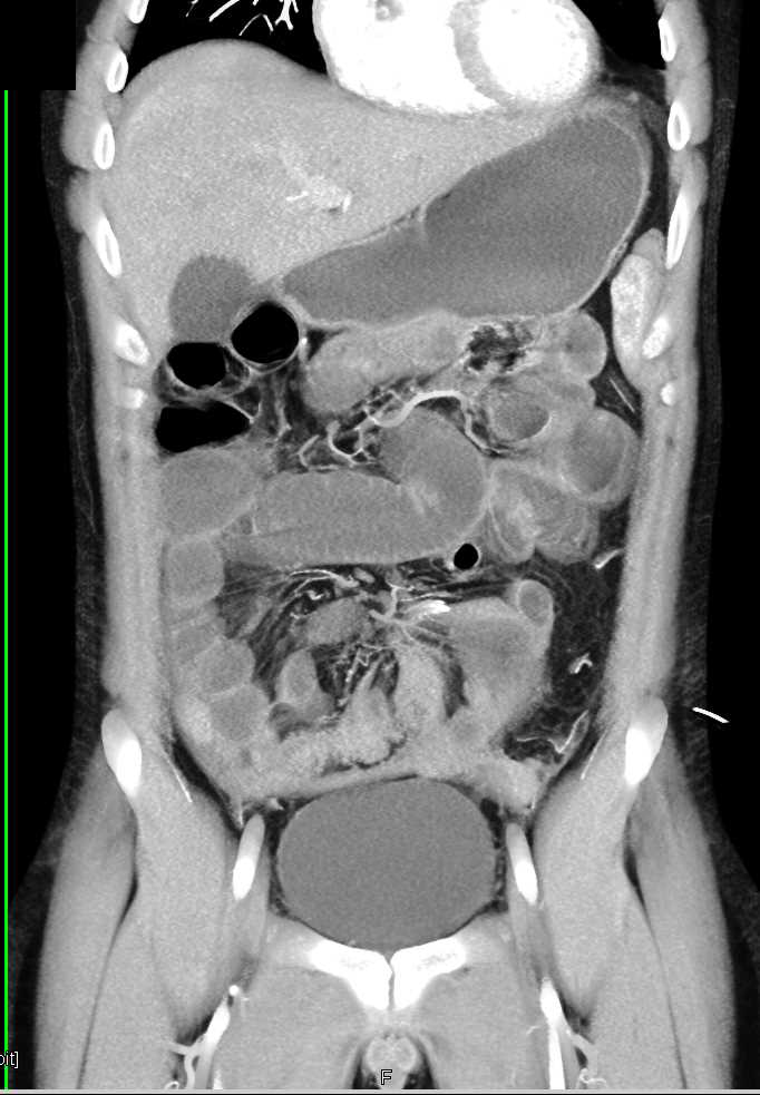 Small Bowel Obstruction - CTisus CT Scan