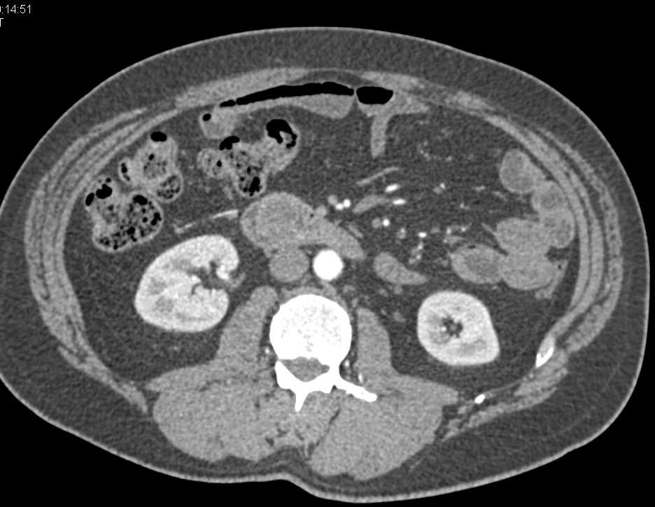 Duodenal Carcinoma in Second Portion of the Duodenum - CTisus CT Scan