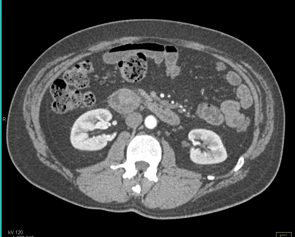 Duodenal Carcinoma in Second Portion of the Duodenum - Small Bowel Case ...