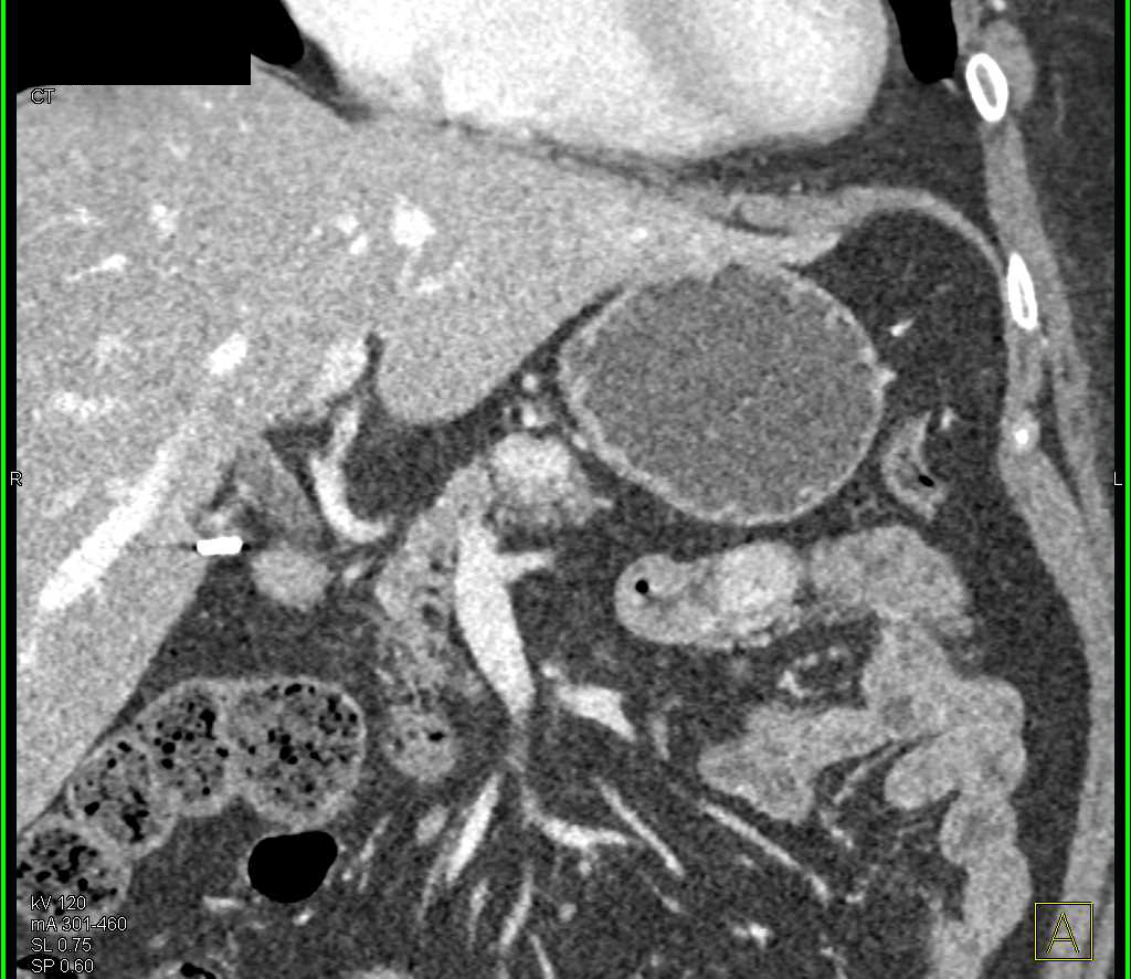 Enhancing GIST Tumor in Jejunum - CTisus CT Scan