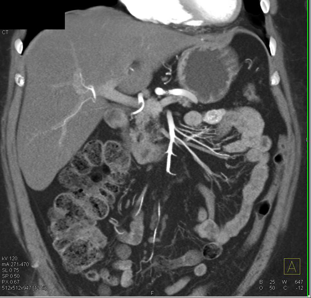 Enhancing GIST Tumor in Jejunum - CTisus CT Scan