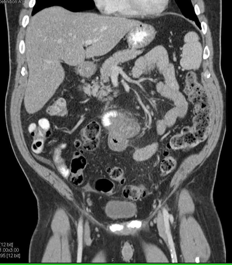 Small Bowel Adenocarcinoma with Perforation - CTisus CT Scan