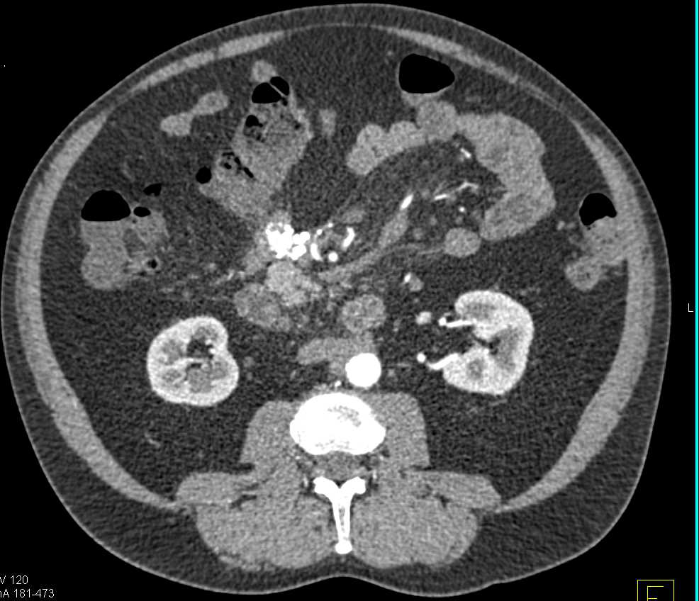 Sclerosing Mesenteritis Simulates a Carcinoid Tumor - Small Bowel Case ...