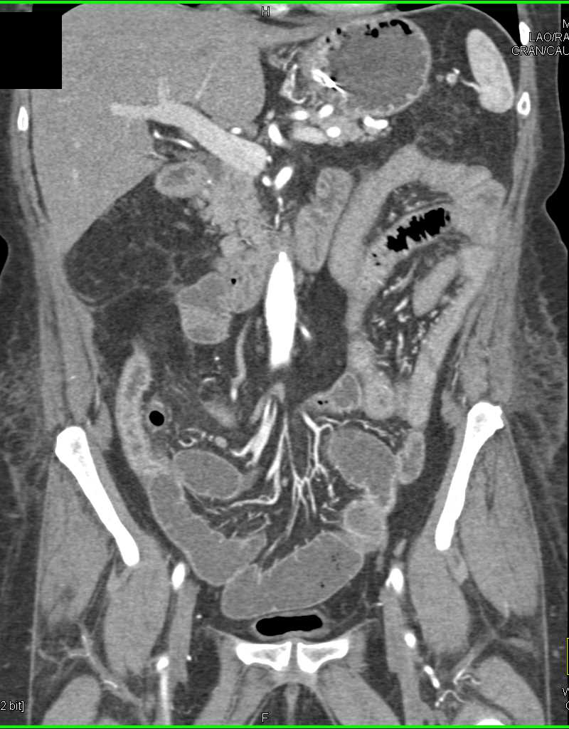 Small Bowel Obstruction (SBO) due to Crohn's Disease with Parastomal Hernia - CTisus CT Scan