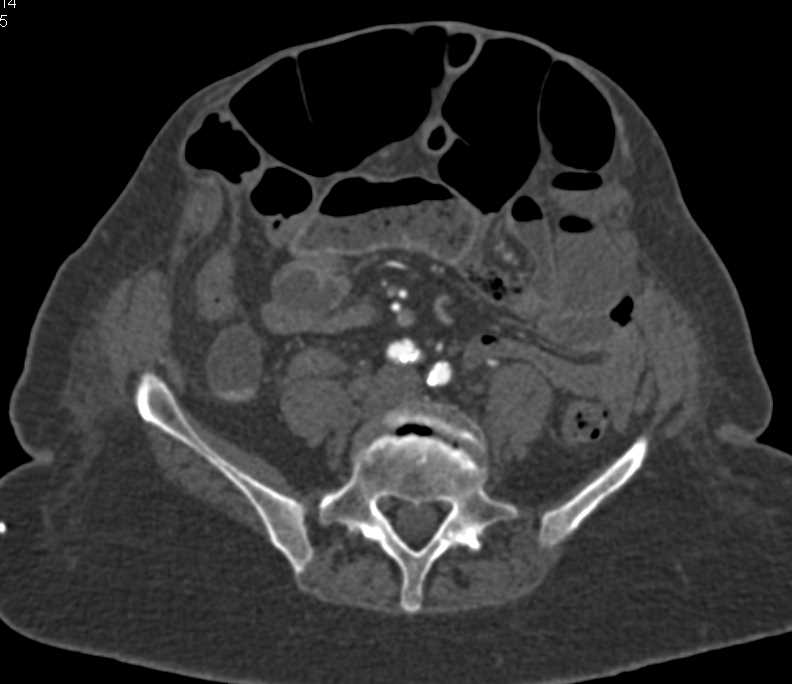 Dilated Small Bowel with Small Bowel Obstruction (SBO) but no Etiology Defined - CTisus CT Scan