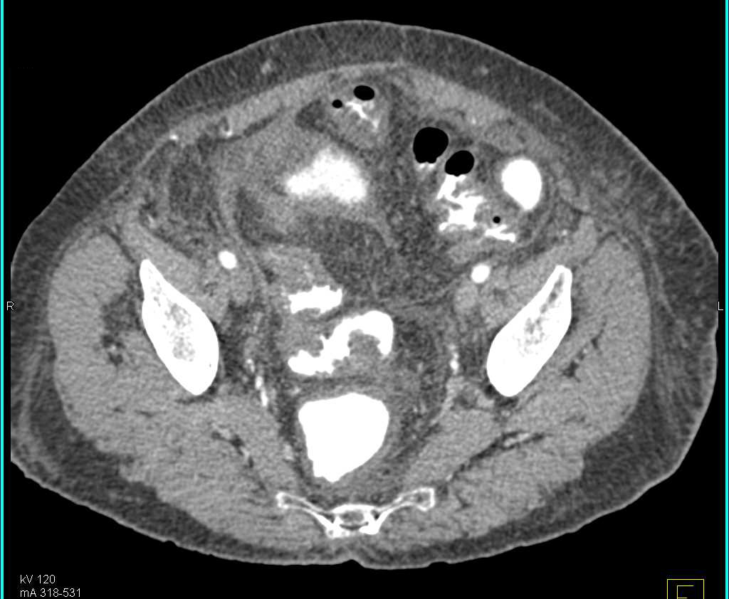 Infectious Enteritis Small Bowel - CTisus CT Scan