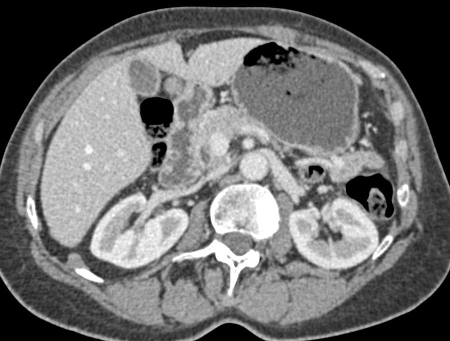 Multiple Duodenal Tumors - CTisus CT Scan