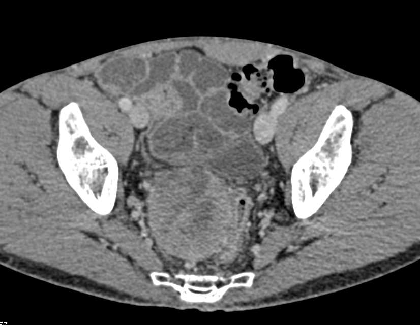 Small Bowel GIST Tumors - CTisus CT Scan