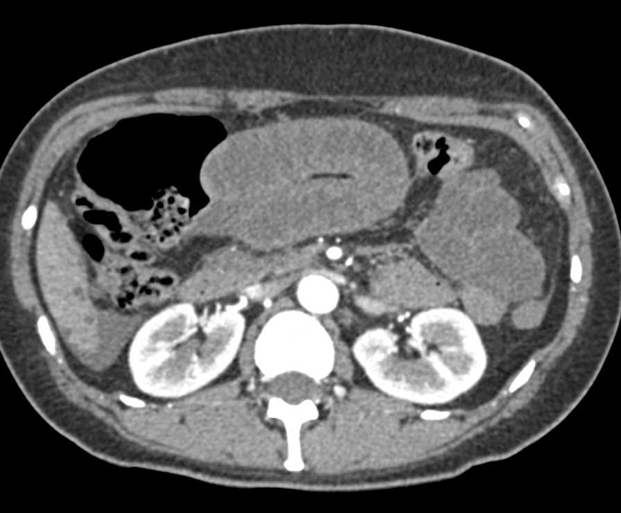 Small Bowel Volvulus with Ischemic Bowel - CTisus CT Scan