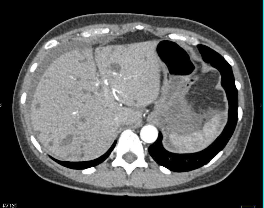 Small Bowel Volvulus with Ischemic Bowel and Decreased Bowel Enhancement - CTisus CT Scan