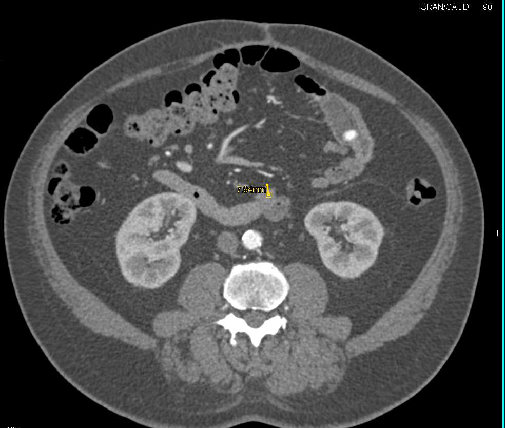 Pill in Small Bowel Simulates a Small Bowel Mass - CTisus CT Scan