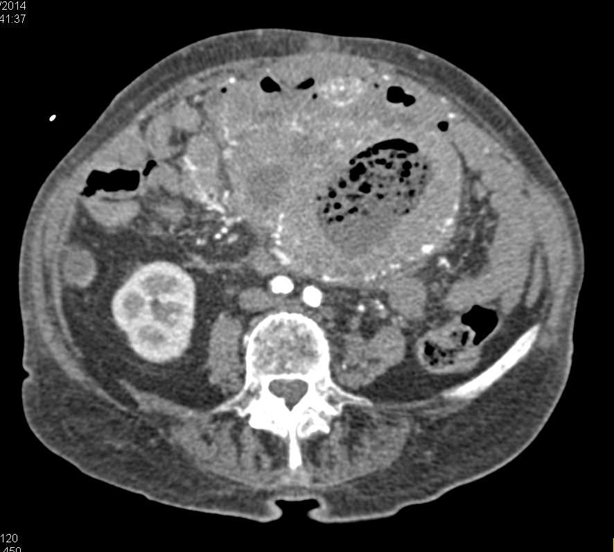 Necrotic GIST Tumor with Increased Vascularity - Small Bowel Case ...