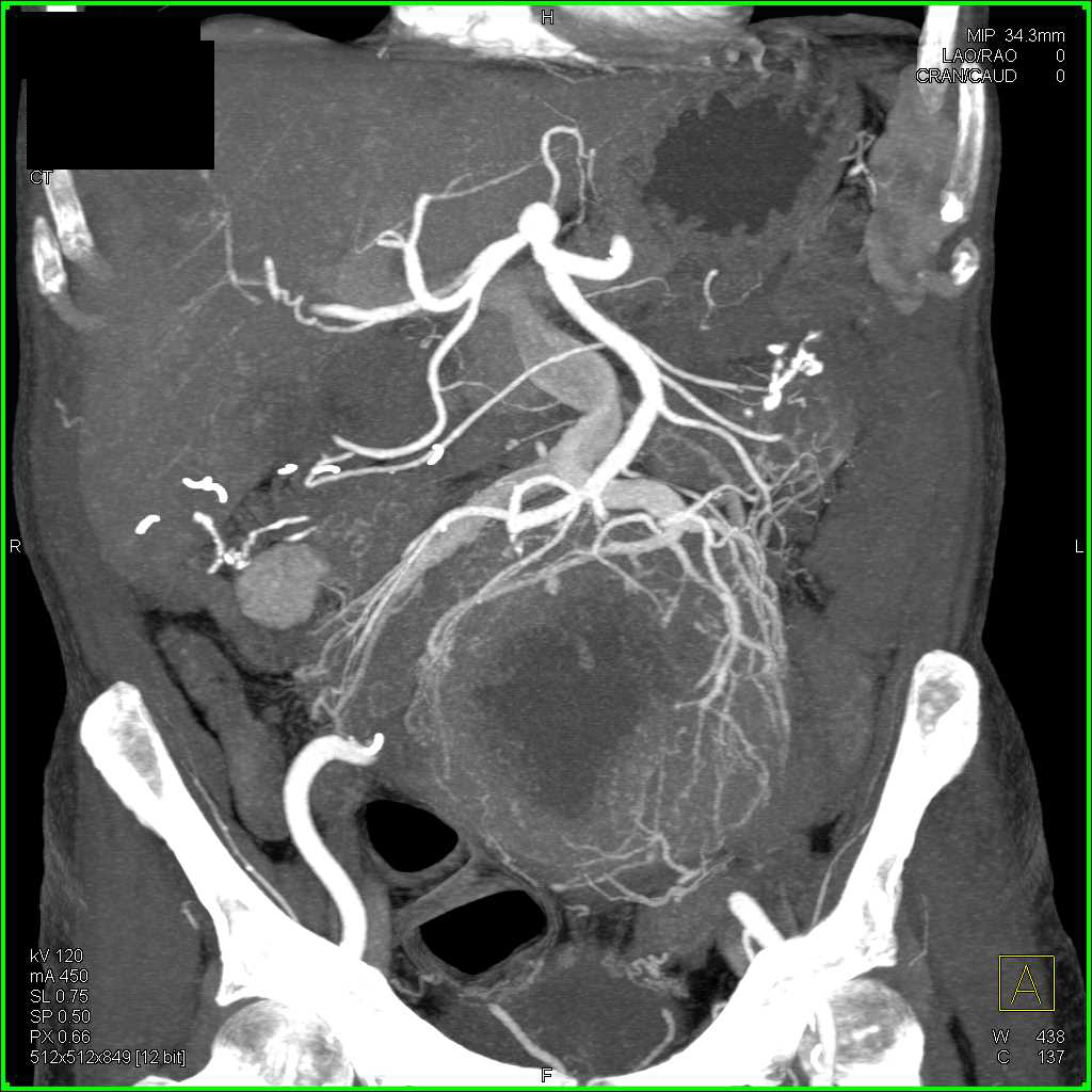 Necrotic GIST Tumor with Increased Vascularity - CTisus CT Scan