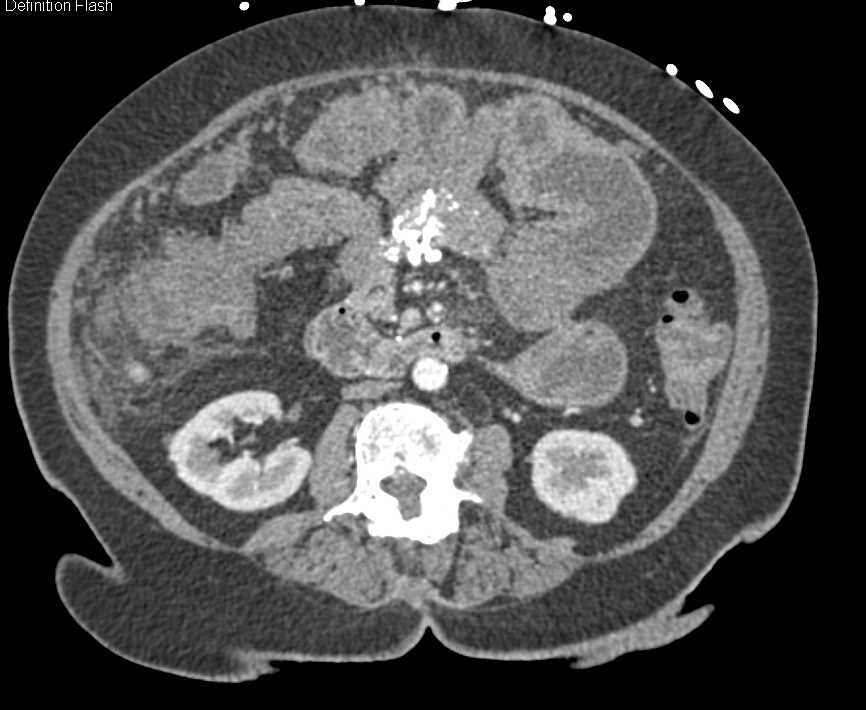 Carcinoid Tumor Root of Mesentery with Desmoplastic Reaction - CTisus CT Scan